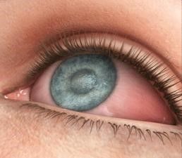  "Cиндром сухого глаза" и как с этим бороться