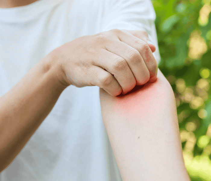 Зуд купальщика4.png