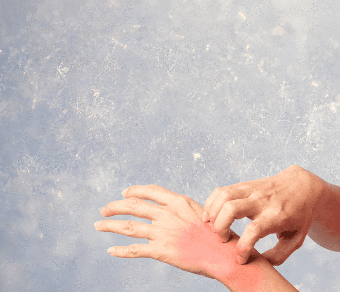 Холодовая аллергия.png